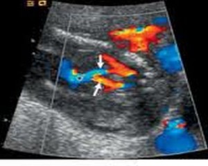 Renal Agenesis