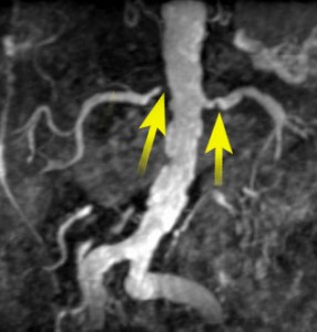 Renal Artery Stenosis
