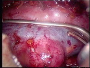 renal parenchyma